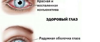 Healthy eye and eye with conjunctivitis