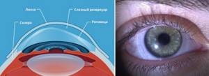 Жесткие склеральные контактные линзы с диоптриями при кератокоунсе