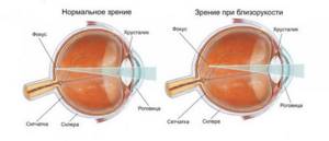 зрение близорукость