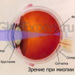 Зрение при миопии (схема)
