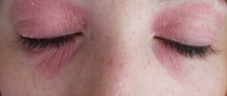 Itchy eyes - causes, treatment and prevention!